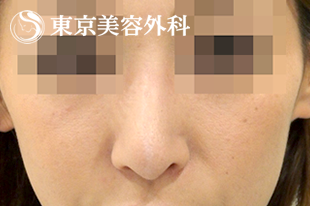 鼻中隔延長症例写真