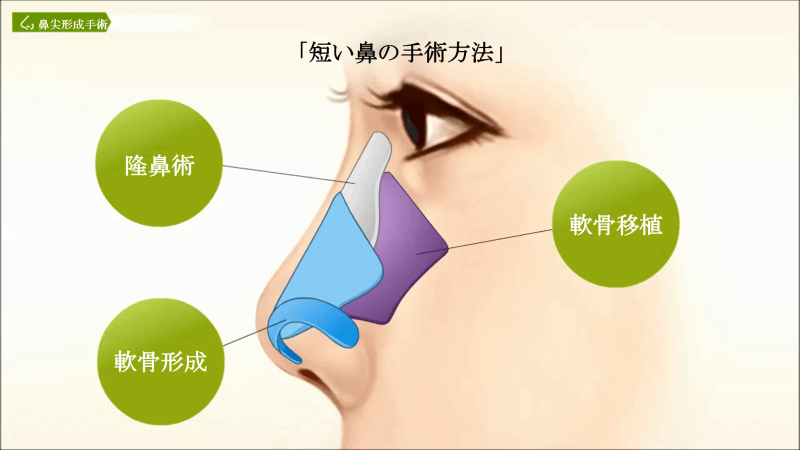 短い鼻の手術方法