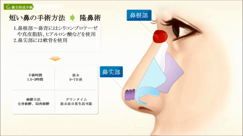 短い鼻の手術方法：隆鼻術