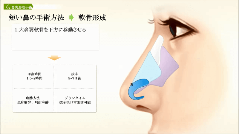 短い鼻の手術方法：鼻中隔延長