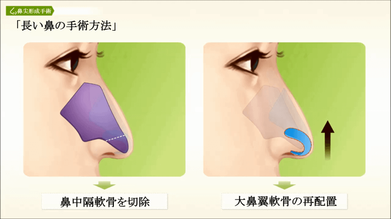 長い鼻の改善方法