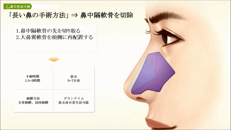 長い鼻の改善方法:鼻中隔軟骨の切除