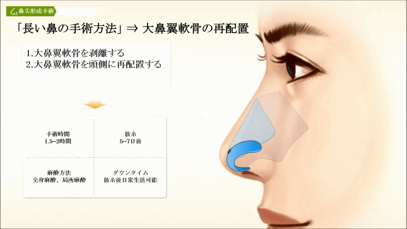 長い鼻の改善方法:大鼻翼軟骨の再配置