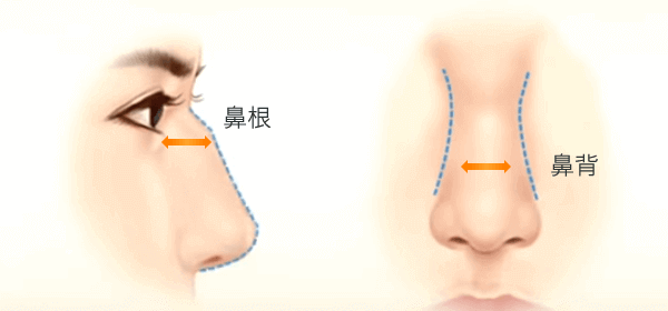 鷲鼻削り ハンプ削り 美容整形は東京美容外科