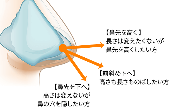 軟骨を挿入説明画像