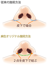 従来の縫合と麻生オリジナル施術方法の縫合