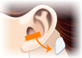 患者さま本人の耳から採取した耳介軟骨