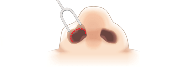 隆鼻術のクローズ法