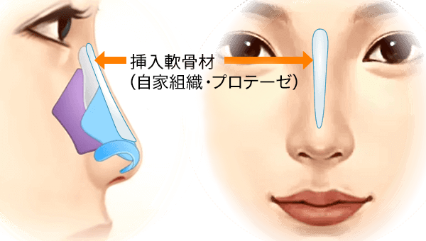 鼻全体を高くしたい方のプロテーゼ挿入位置