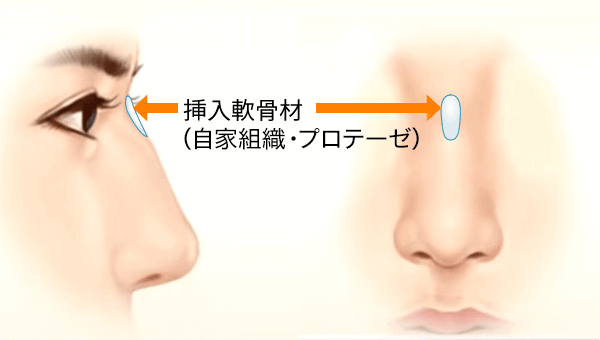 鼻筋を長くしたい方・ワシ鼻を治したい方のプロテーゼ挿入位置
