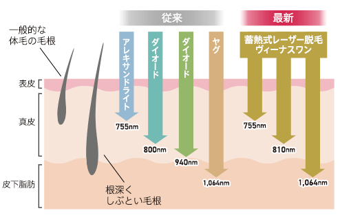 蓄熱式レーザー脱毛「ヴィーナスワン」は3波長同時照射が可能