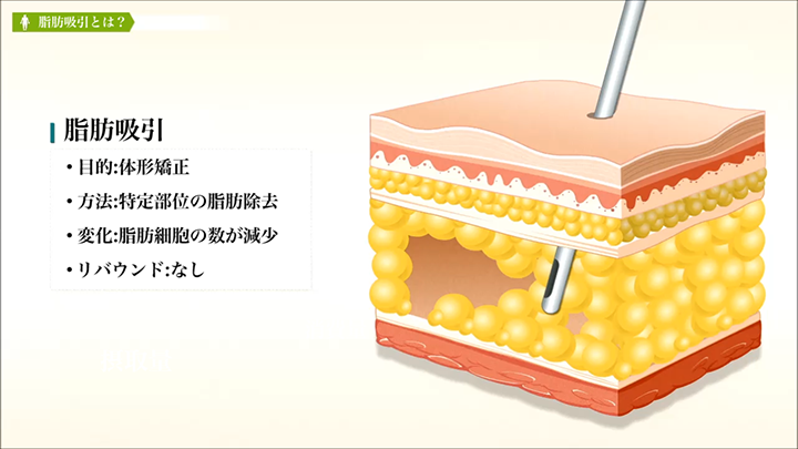 医師監修】～脂肪吸引の手術方法～ | 美容整形は東京美容外科