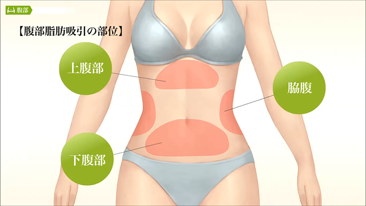 医師監修 腹部の脂肪吸引 特徴 美容整形は東京美容外科