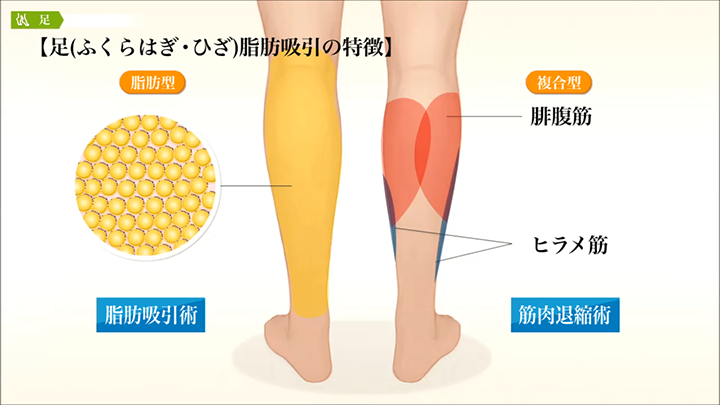 医師監修 足の脂肪吸引 特徴 美容整形は東京美容外科