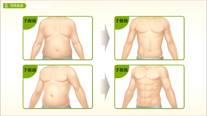 医師監修 男性腹部の脂肪吸引 手術方法 美容整形は東京美容外科