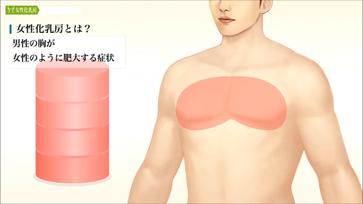 医師監修 女性化乳房の脂肪吸引 特徴 美容整形は東京美容外科