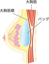 乳腺下法は大胸筋の外側にバッグを挿入します