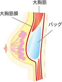 大胸筋下法は大胸筋の内側にバッグを挿入します