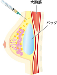 ハイブリッド豊胸