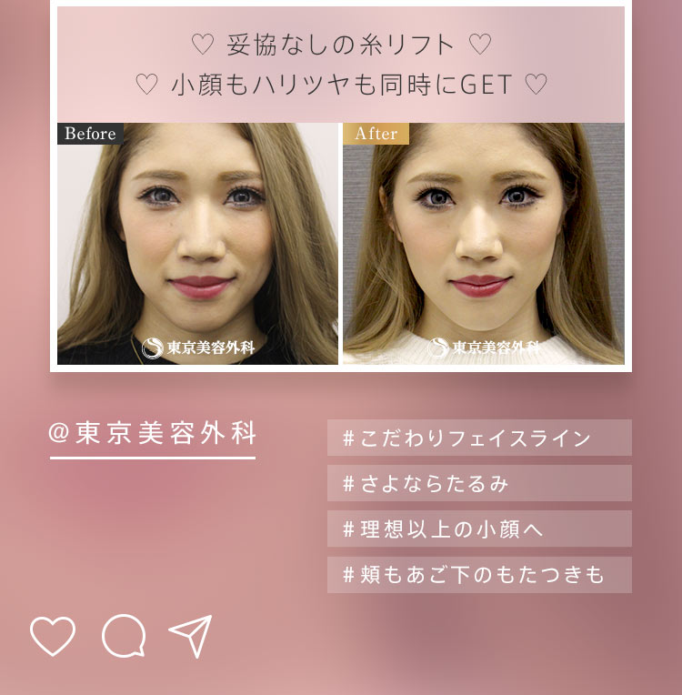 ＠東京美容外科 ＃こだわりフェイスライン ＃さよならたるみ ＃理想以上の小顔へ ＃頬もあご下のもたつきも