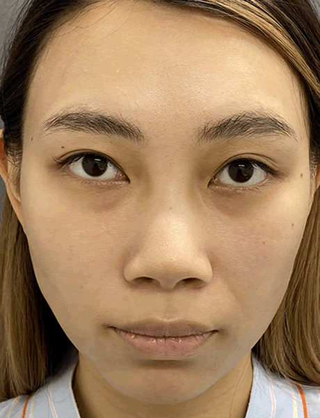 オーダーメイド鼻整形　症例02 before
