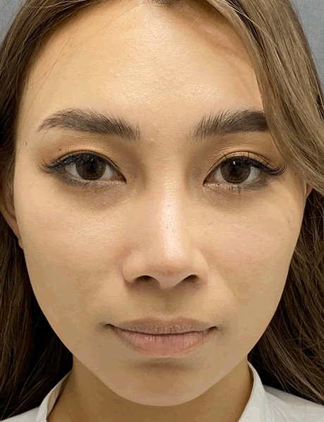 オーダーメイド鼻整形　症例02 after