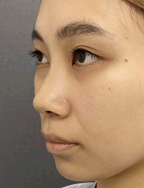 オーダーメイド鼻整形　症例02 before