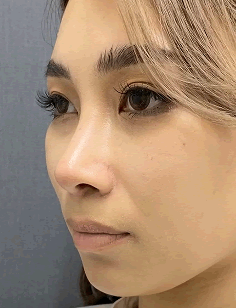 オーダーメイド鼻整形　症例02 after