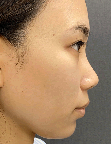 オーダーメイド鼻整形　症例02 before