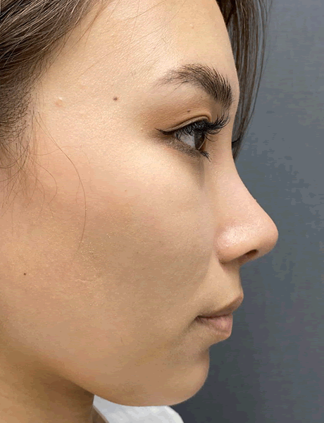 オーダーメイド鼻整形　症例02 after