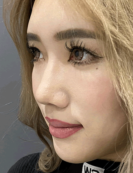 オーダーメイド鼻整形　症例03 before