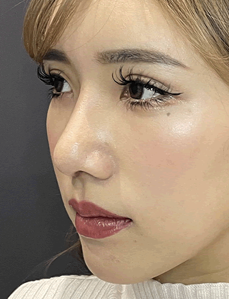 オーダーメイド鼻整形　症例03 after