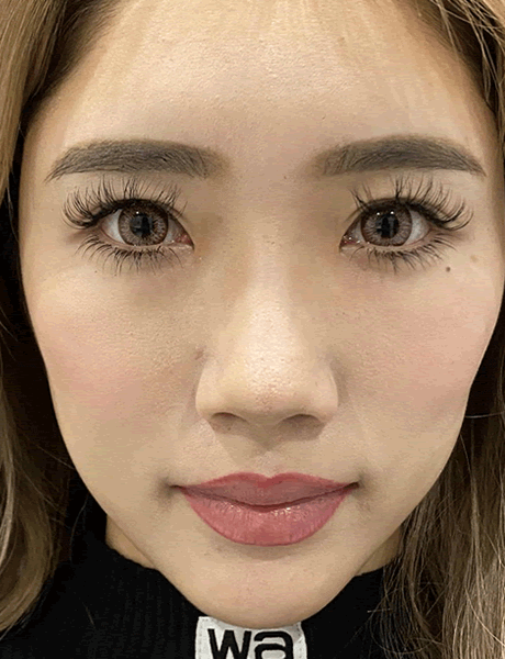 オーダーメイド鼻整形　症例03 before