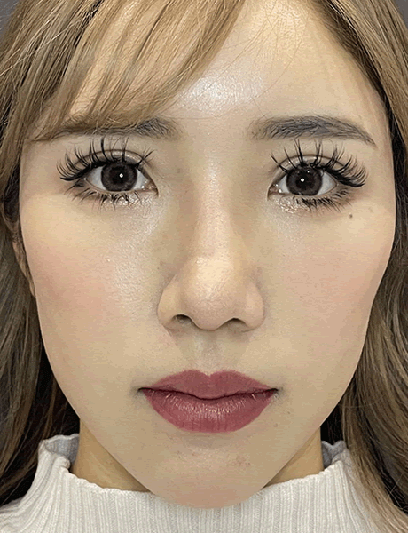 オーダーメイド鼻整形　症例03 after