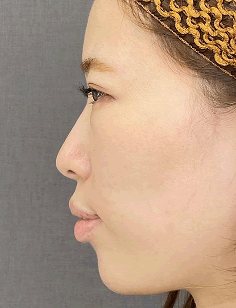 オーダーメイド鼻整形　症例04 before