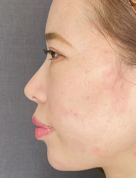 オーダーメイド鼻整形　症例04 after