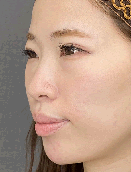オーダーメイド鼻整形　症例04 before