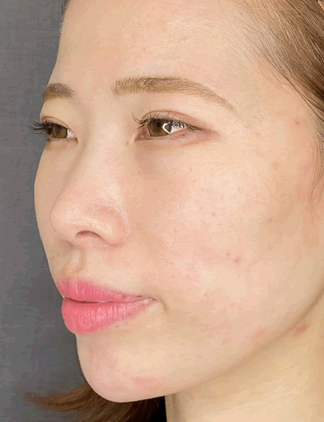 オーダーメイド鼻整形　症例04 after