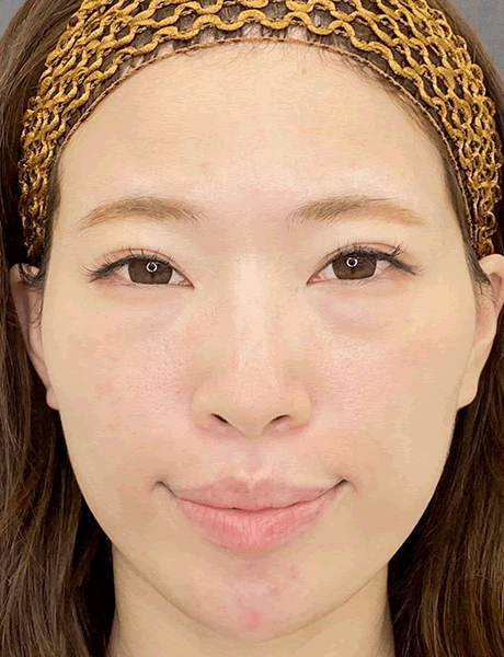 オーダーメイド鼻整形　症例04 before