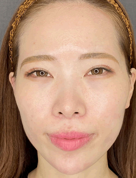 オーダーメイド鼻整形　症例04 after