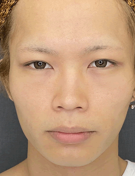 オーダーメイド鼻整形　症例05 before