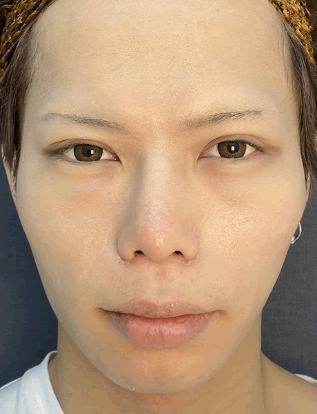 オーダーメイド鼻整形　症例05 after