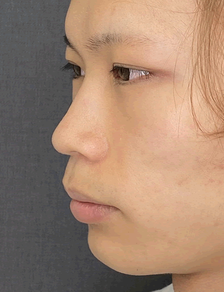 形成外科専門医による鼻整形|美容整形は東京美容外科