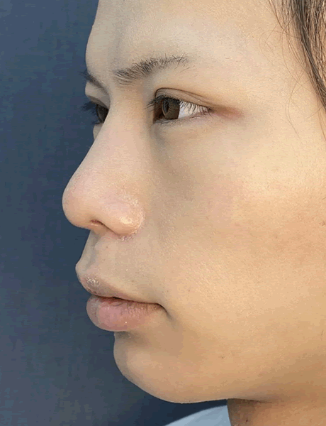 オーダーメイド鼻整形　症例05 after