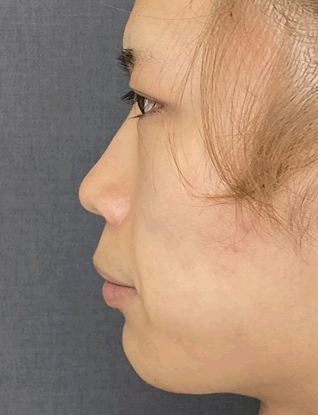 オーダーメイド鼻整形　症例05 before