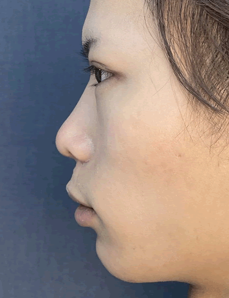 オーダーメイド鼻整形　症例05 after