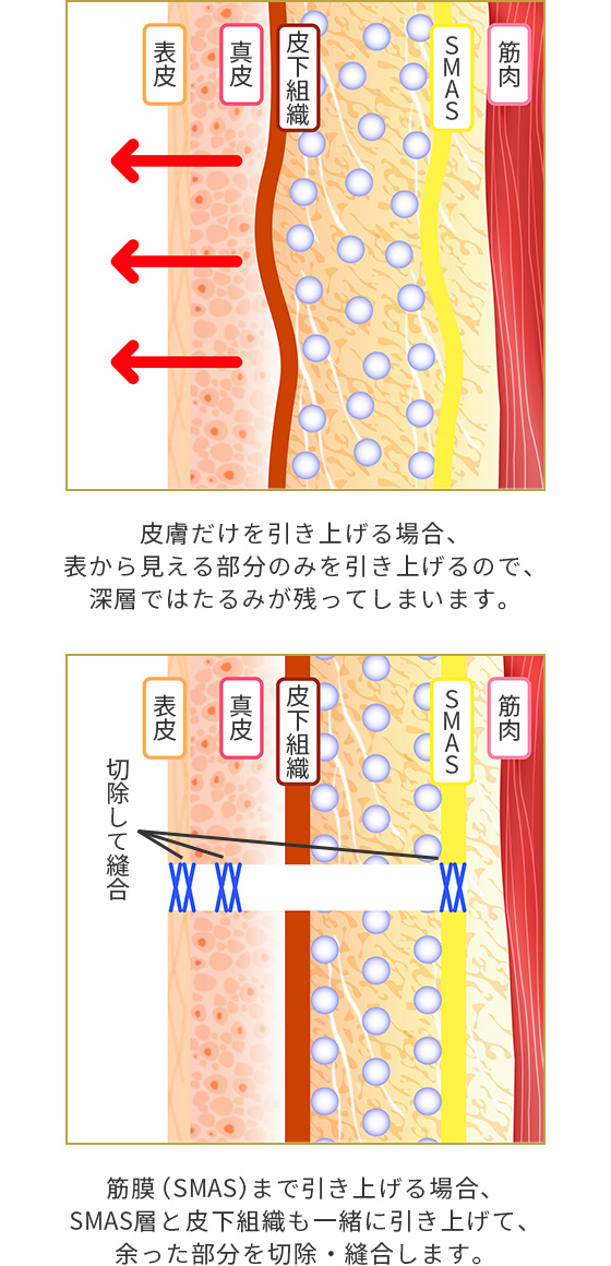 フェイスリフト 美容整形は東京美容外科 フェイスリフト 美容整形は東京美容外科
