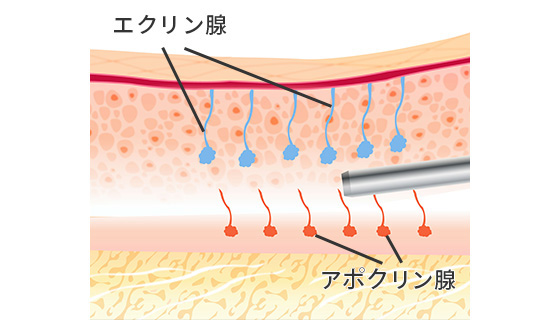 の 特徴 ワキガ ワキガに悩む女性に知ってほしい。脇が臭くなる人の6つの特徴と対策