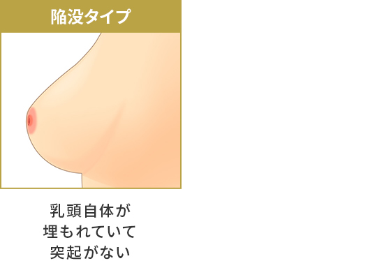 陥没乳頭 美容整形は東京美容外科 陥没乳頭 美容整形は東京美容外科