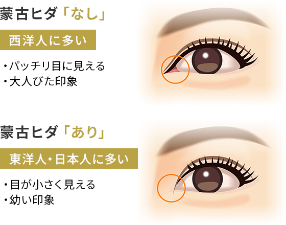 目頭切開による二重まぶた整形 美容整形は東京美容外科